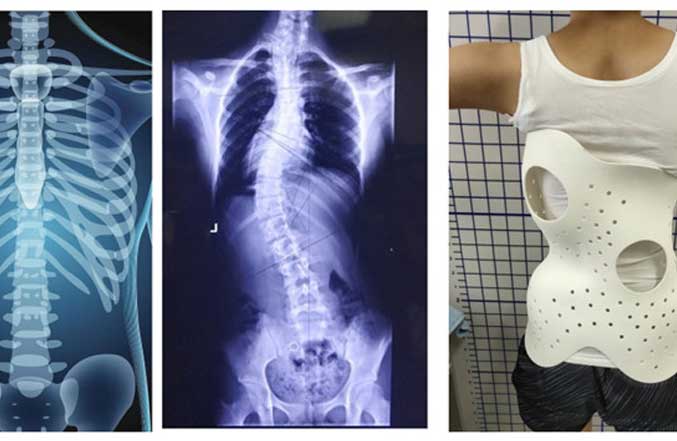 Scoliosis Orthoses - A Typical Application of SLS 3D Printing