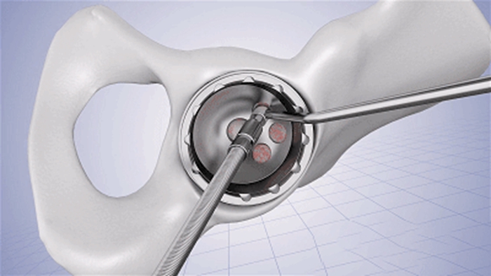 Machining, 3D Printing and Implantation Process of Acetabular Cup