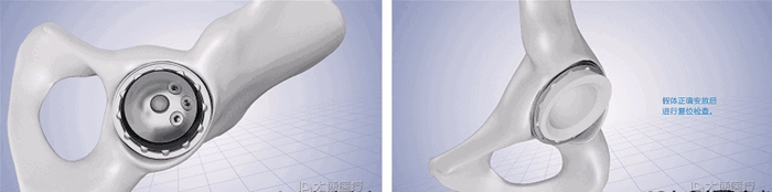 Machining, 3D Printing and Implantation Process of Acetabular Cup