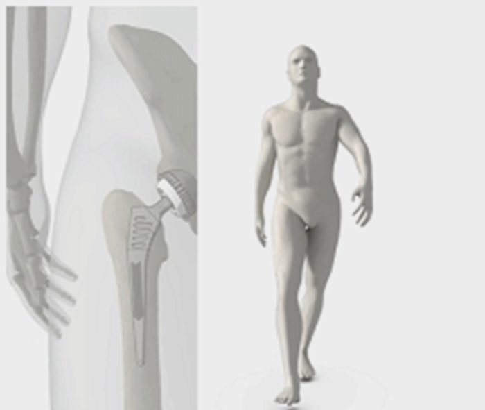 Machining, 3D Printing and Implantation Process of Acetabular Cup