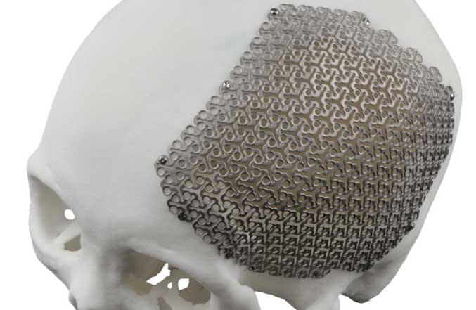 Manufacturing and Materials of 3D Printed Cranial Plates