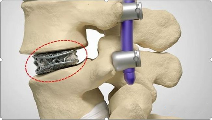 Why is Titanium Alloy Widely Used in Medical Industry of 3D Printing?