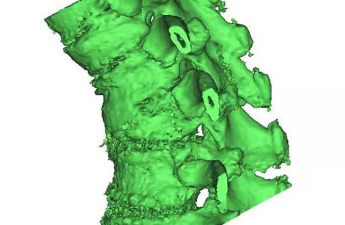 3D Printed Surgical Guide for Medical Application