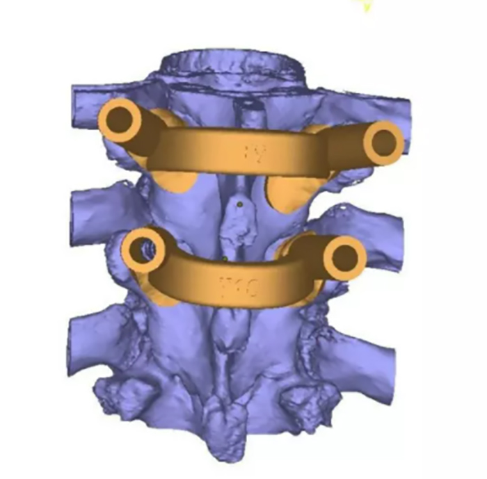 3D Printed Surgical Guide for Medical Application