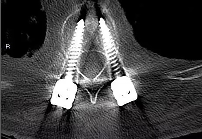 3D Printed Surgical Guide for Medical Application