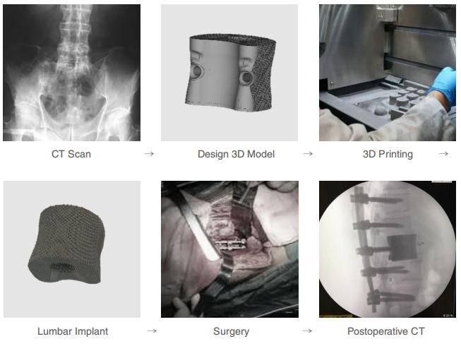 Direct 3D Printed Titanium Alloy Spinal Implants