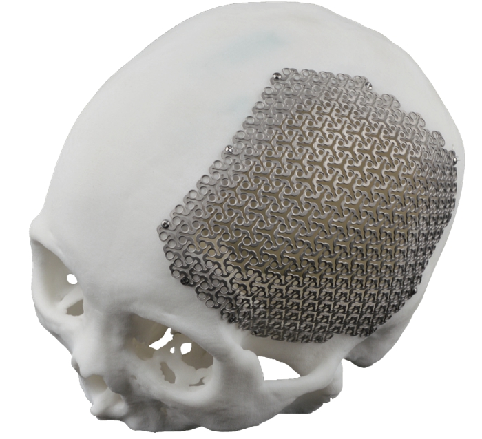 Manufacturing and Materials of 3D Printed Cranial Plates