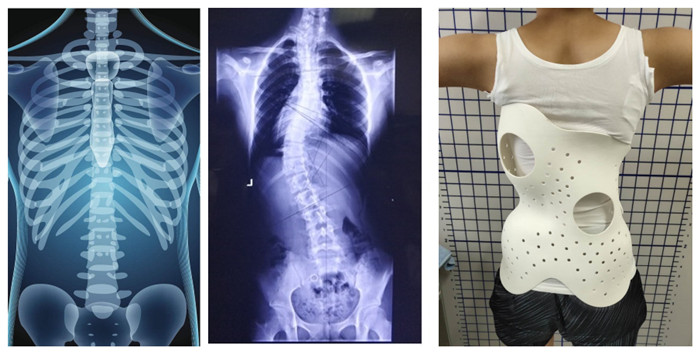 Scoliosis Orthoses - A Typical Application of SLS 3D Printing