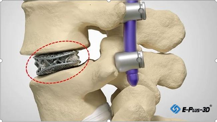 Spinal Implant Manufacturing Using EP-M250 Metal 3D Printer