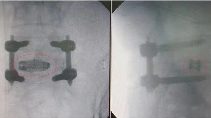 Spinal Implant Manufacturing Using EP-M250 Metal 3D Printer