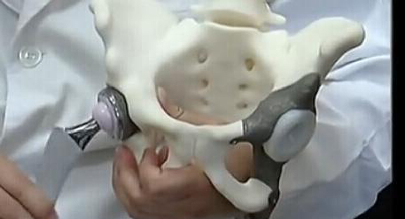 3D Printing For Orthopedic Implant