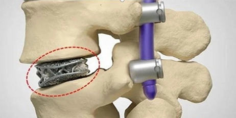 What Metal Material is More Suitable for Implants Printing? - Take an Injured Cat as an Example